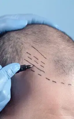 Haartransplantation