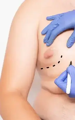 GYNECOMASTIA