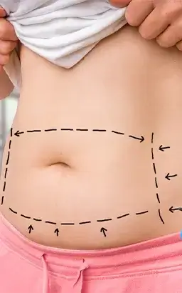 Abdominoplastie