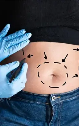 LIPOSUCTION