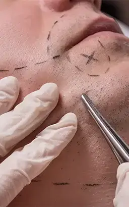 BEARD TRANSPLANTATION