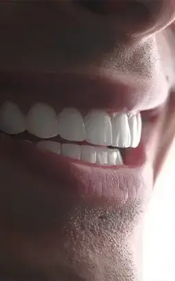 DENTAL VENEERS